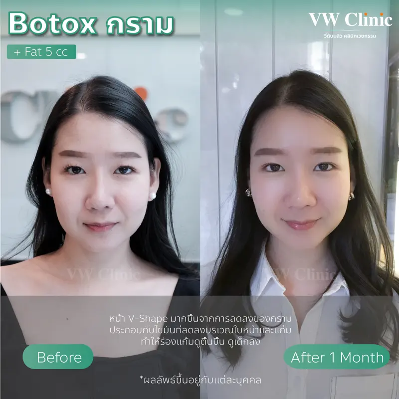 ฺBotox กราม