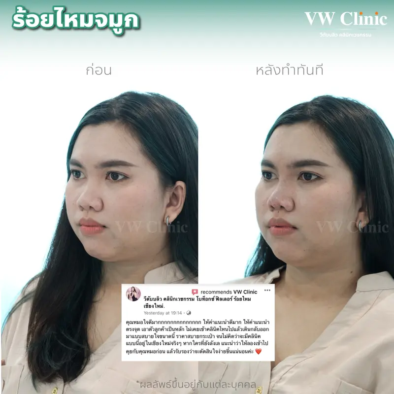 ร้อยไหมจมูก