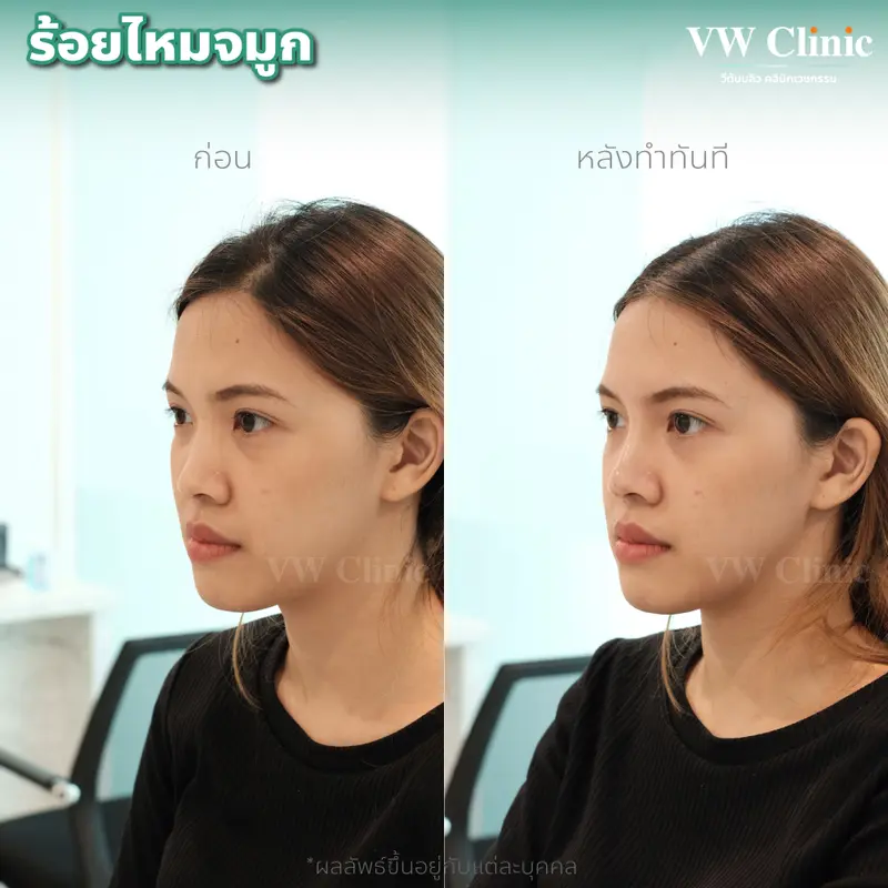 ร้อยไหมจมูก