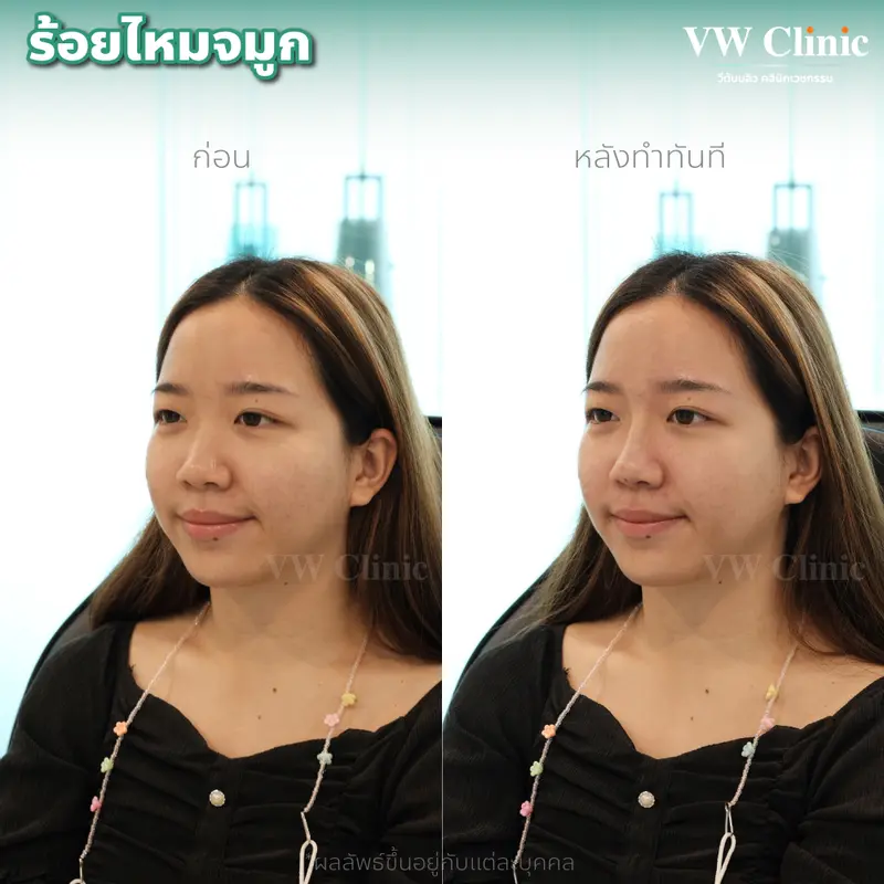 ร้อยไหมจมูก