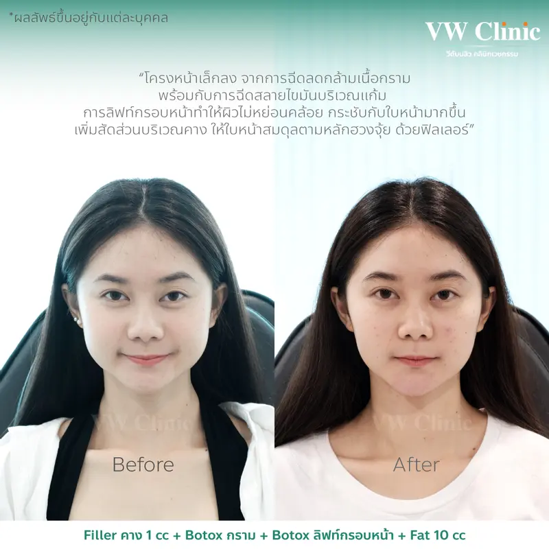 Filler + Botox + MesoFat