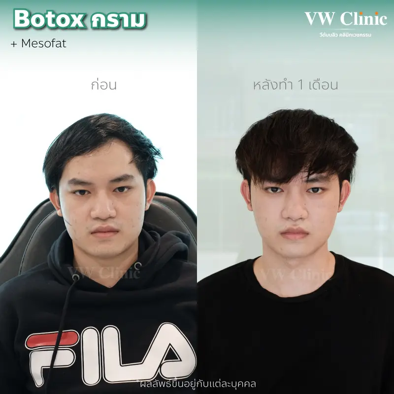 Botox กราม
