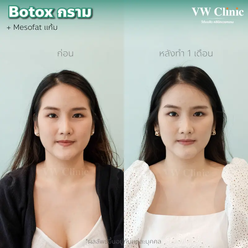 Botox กราม
