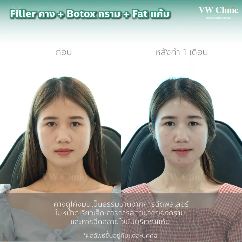 Filler + Botox + Fat