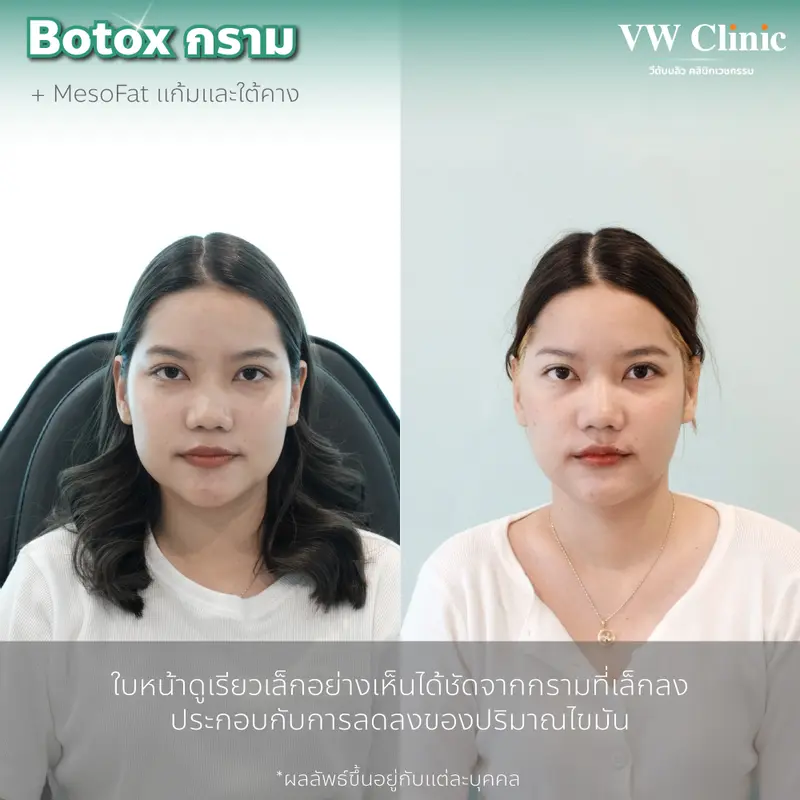 Botox กราม 