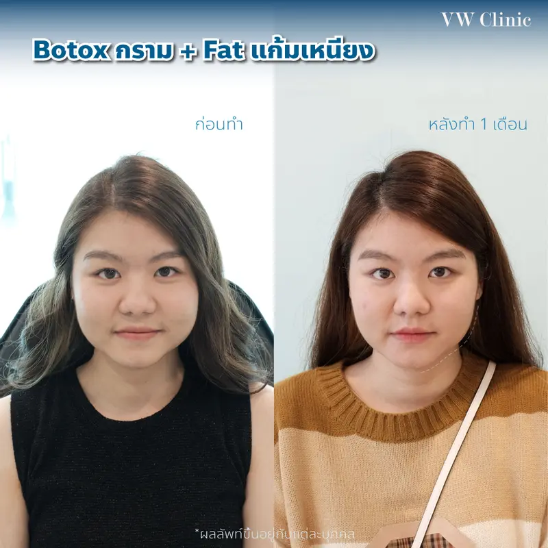Botox กราม + Fat แก้มเหนียง