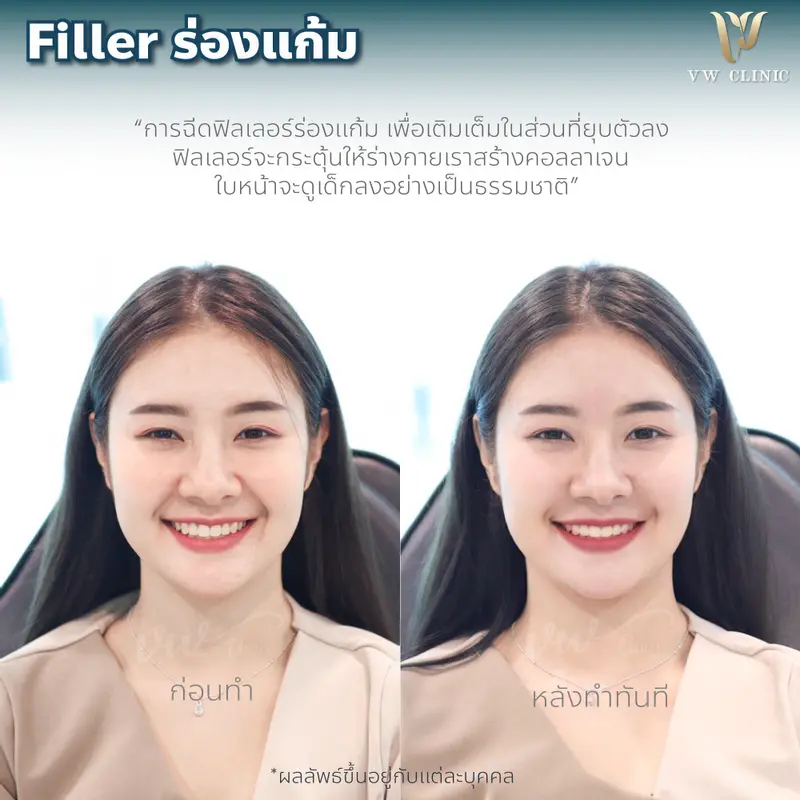 Filler ร่องแก้ม