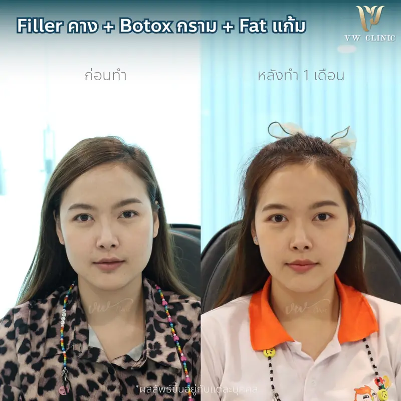 Filler คาง + Botox กราม + Fat แก้ม