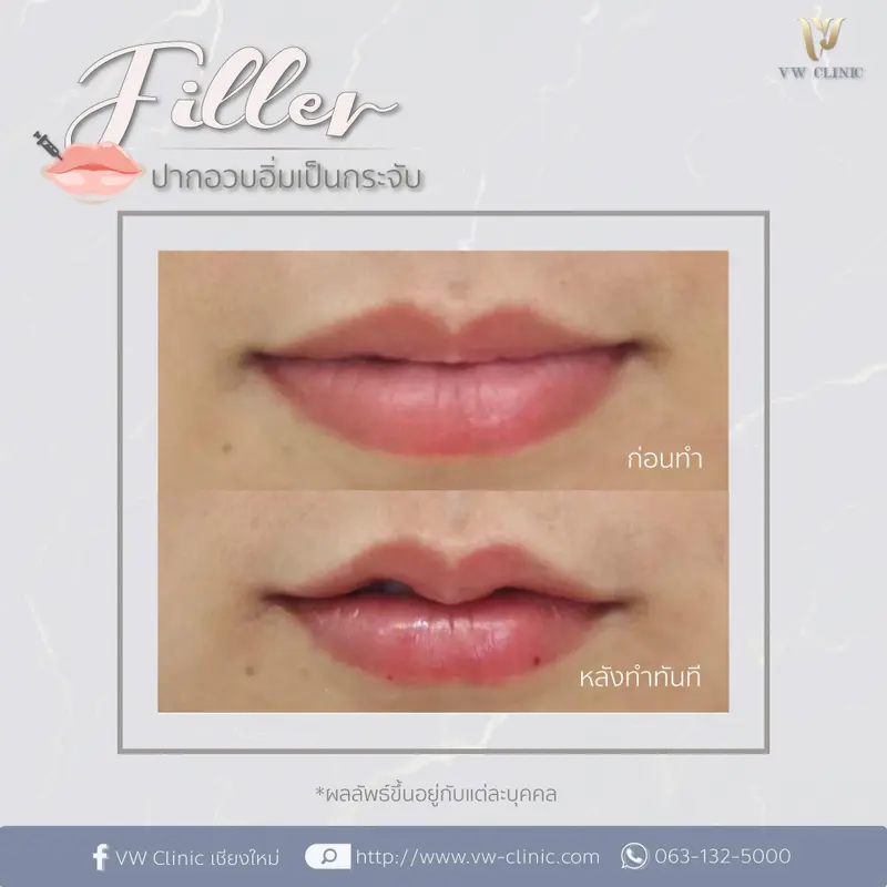 Filler ปาก