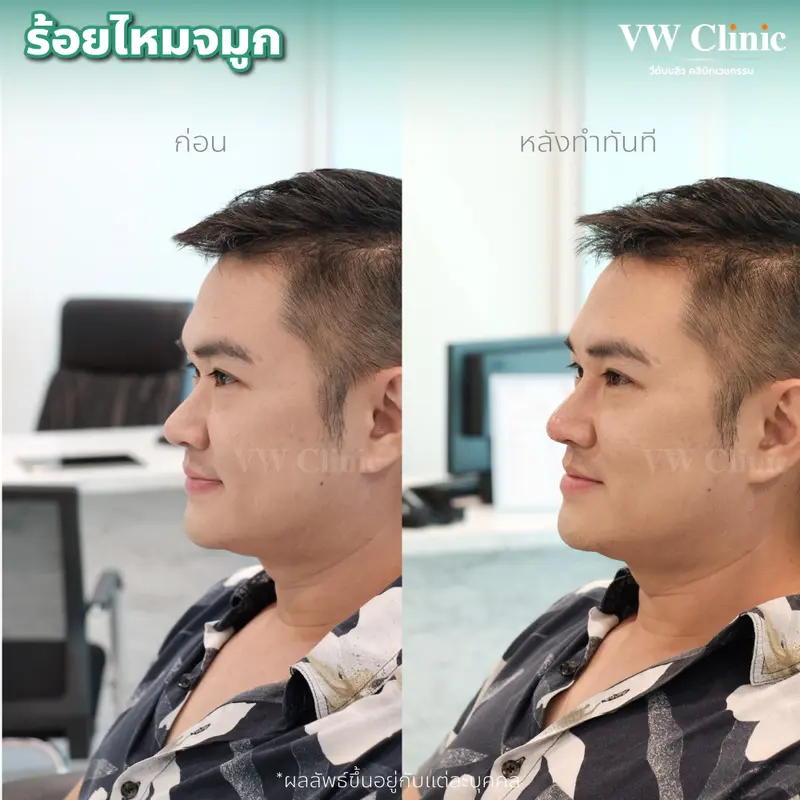 ร้อยไหมจมูก