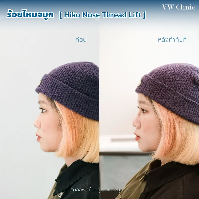 ร้อยไหมจมูก