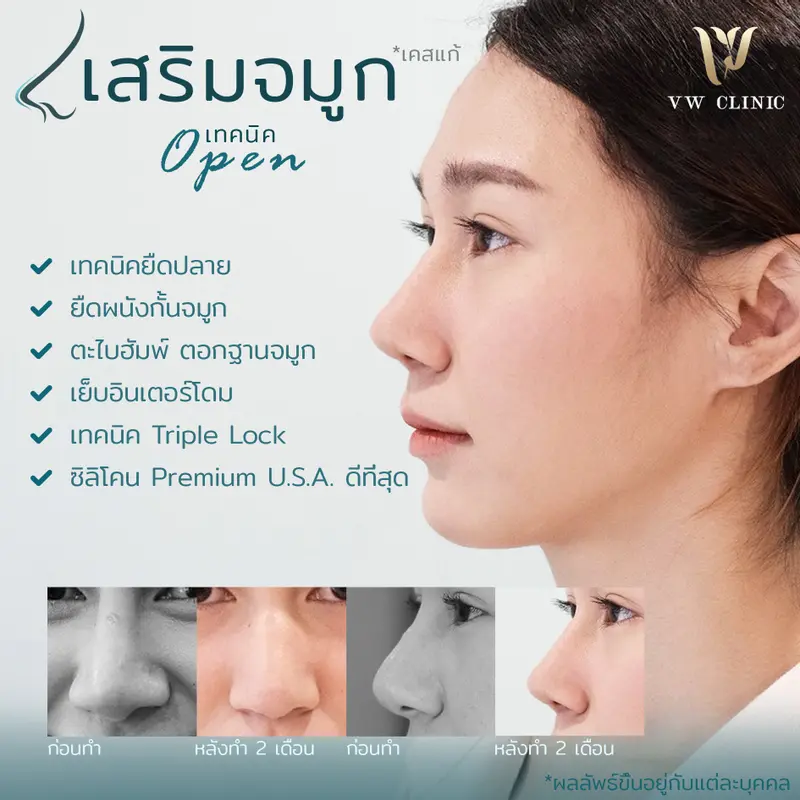 เสริมจมูก