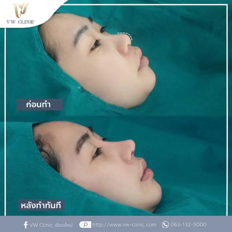 เสริมจมูก