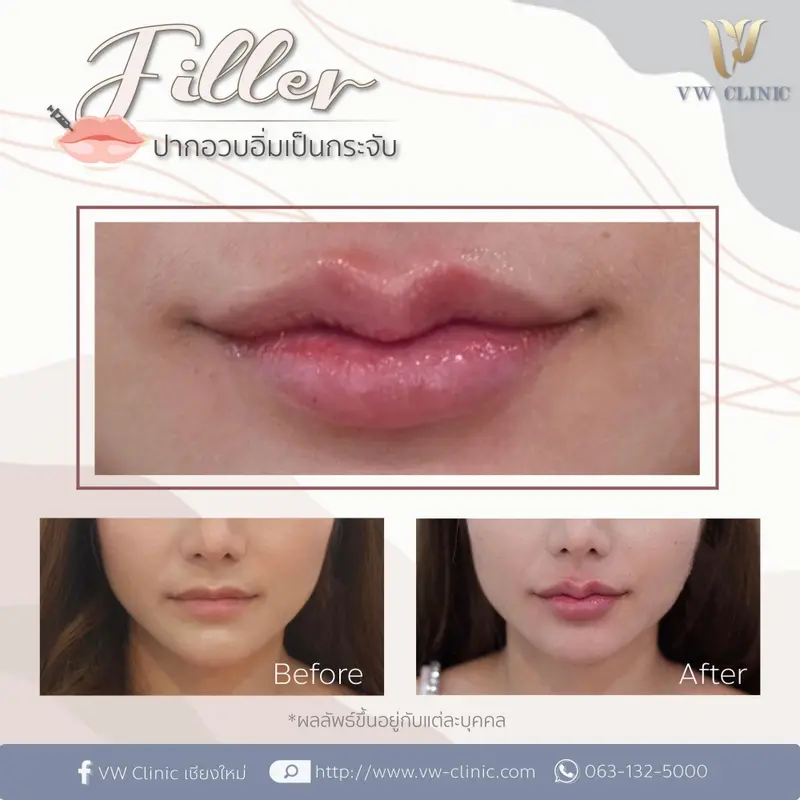 Lips Filler