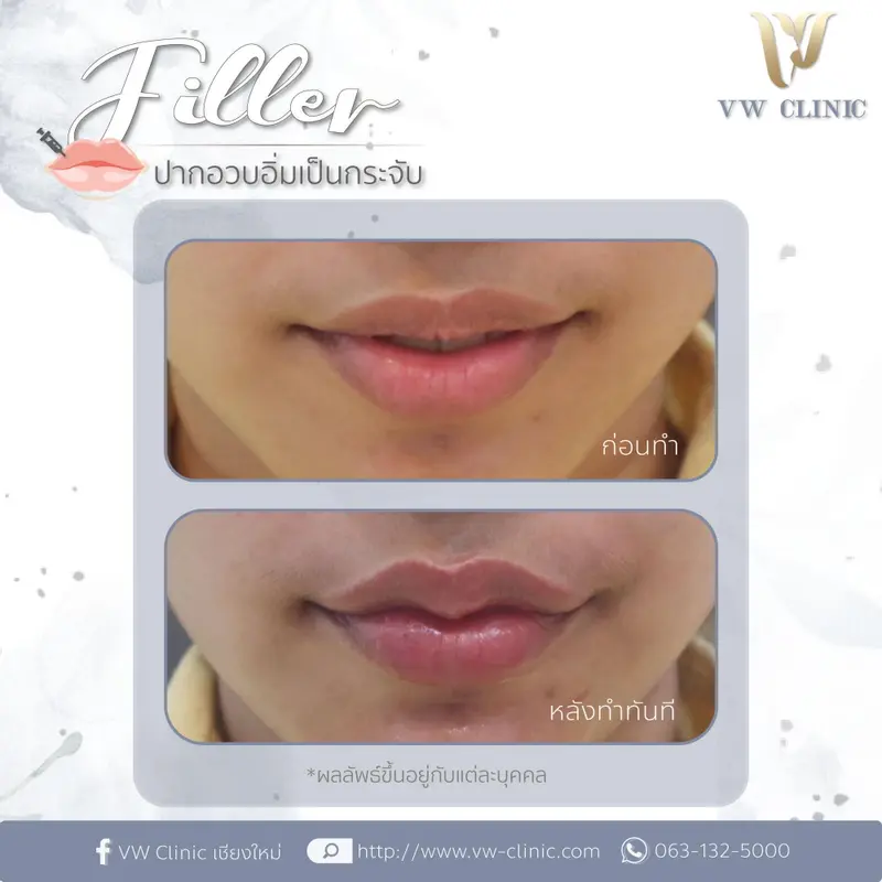 Filler ปาก