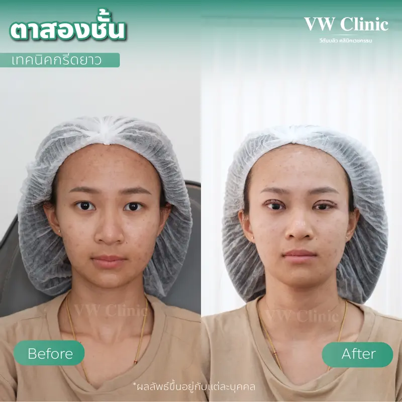 ตาสองชั้น