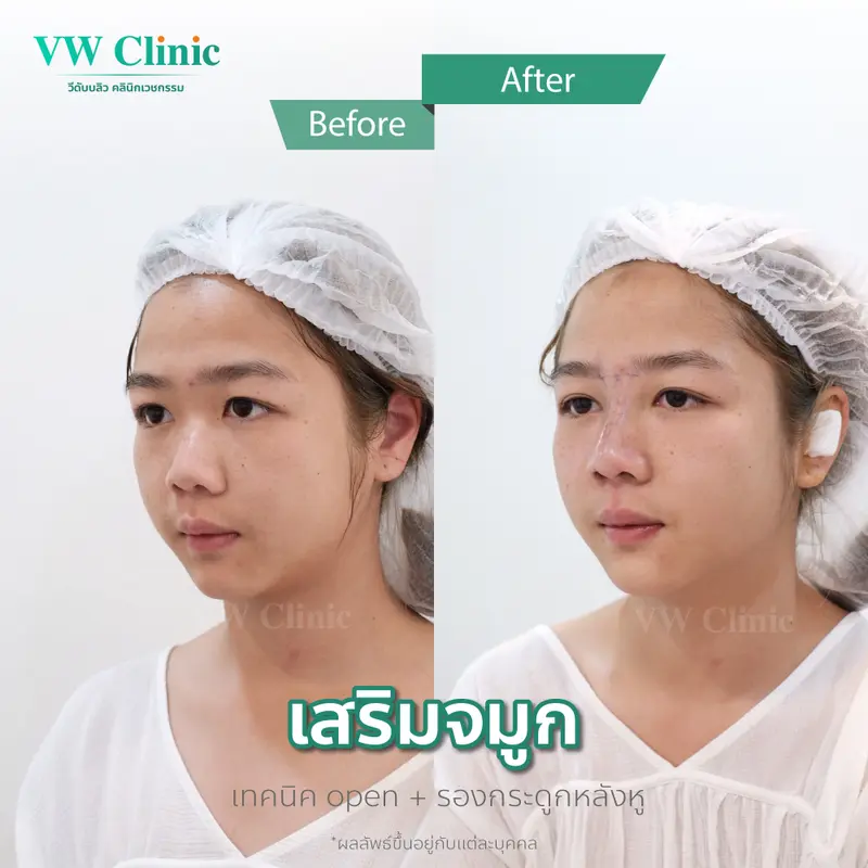 หลังผ่าตัดเสริมจมูกทันที