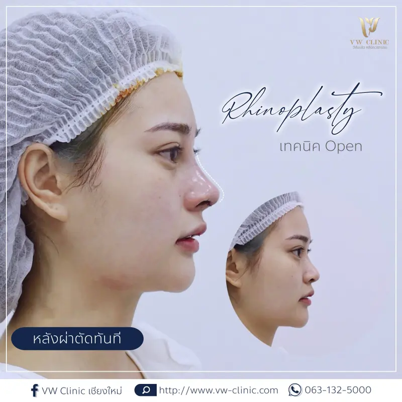 หลังผ่าตัดเสริมจมูกทันที
