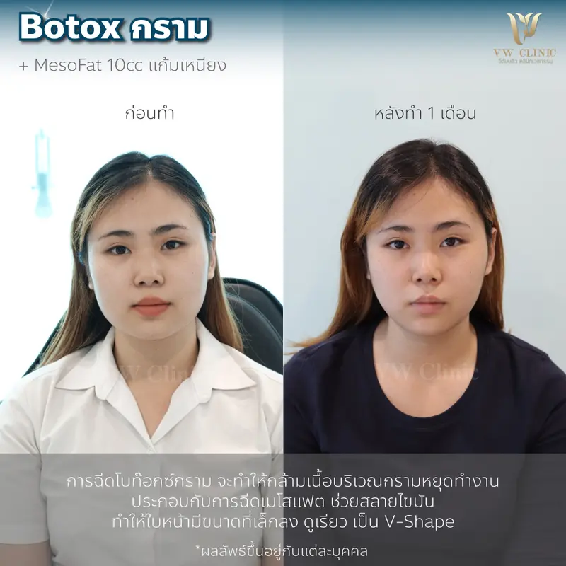 Botox กราม