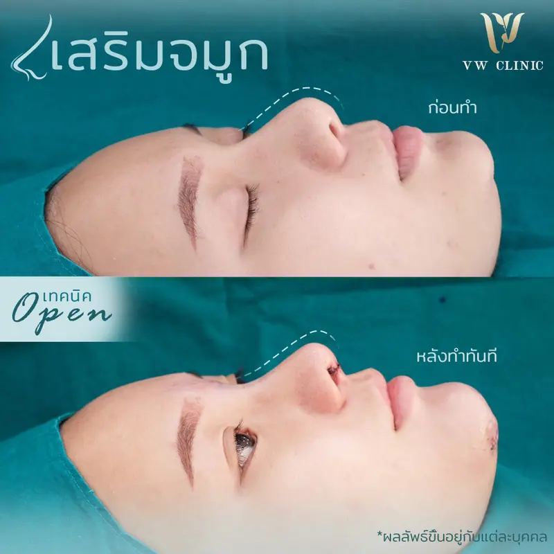 เสริมจมูกโอเพ่น