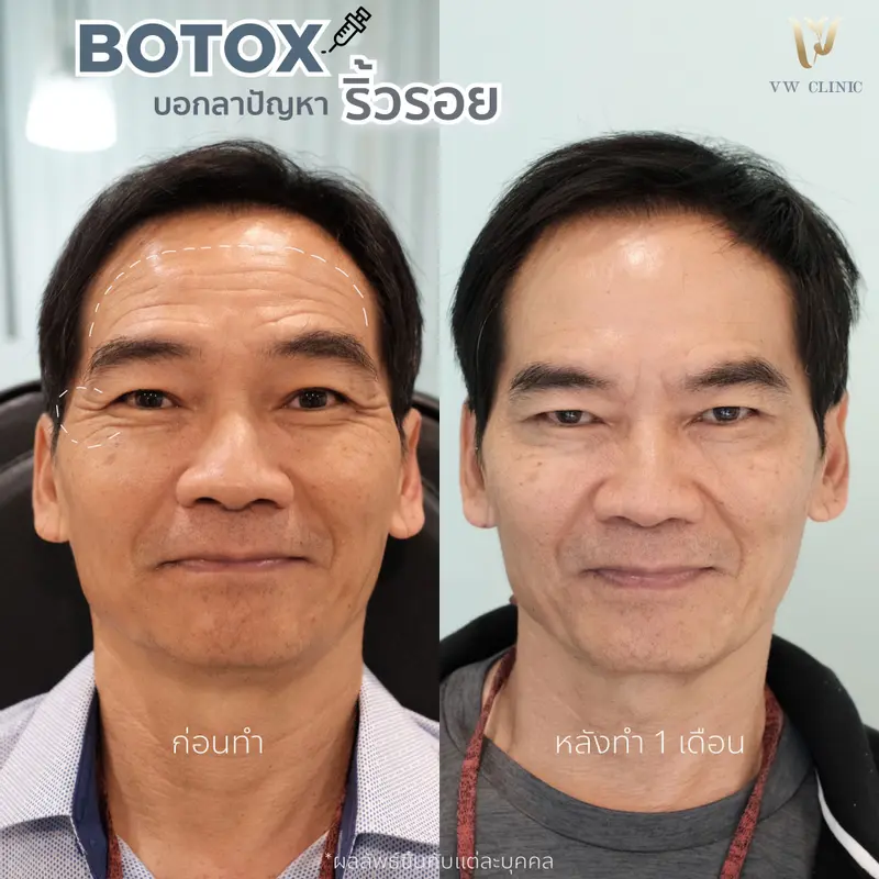 Botox ริ้วรอย