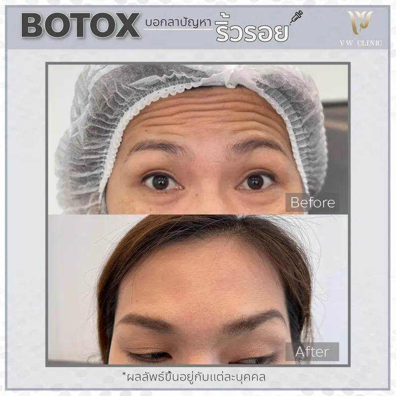 Botox ริ้วรอย