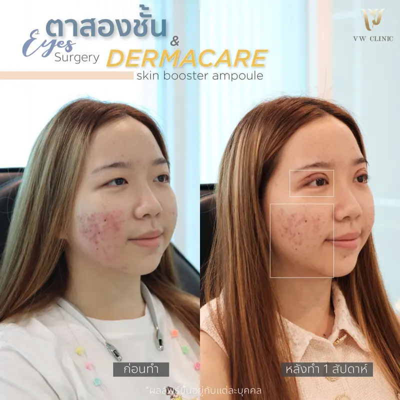 ตาสองชั้น