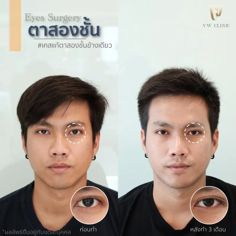 ตาสองชั้น