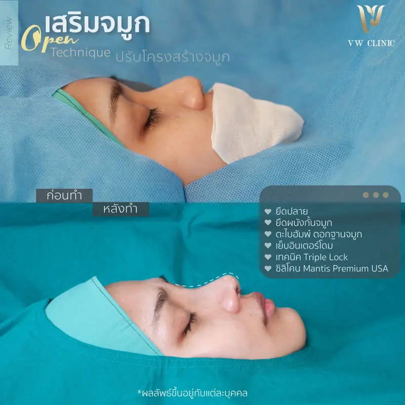 เสริมจมูก Open