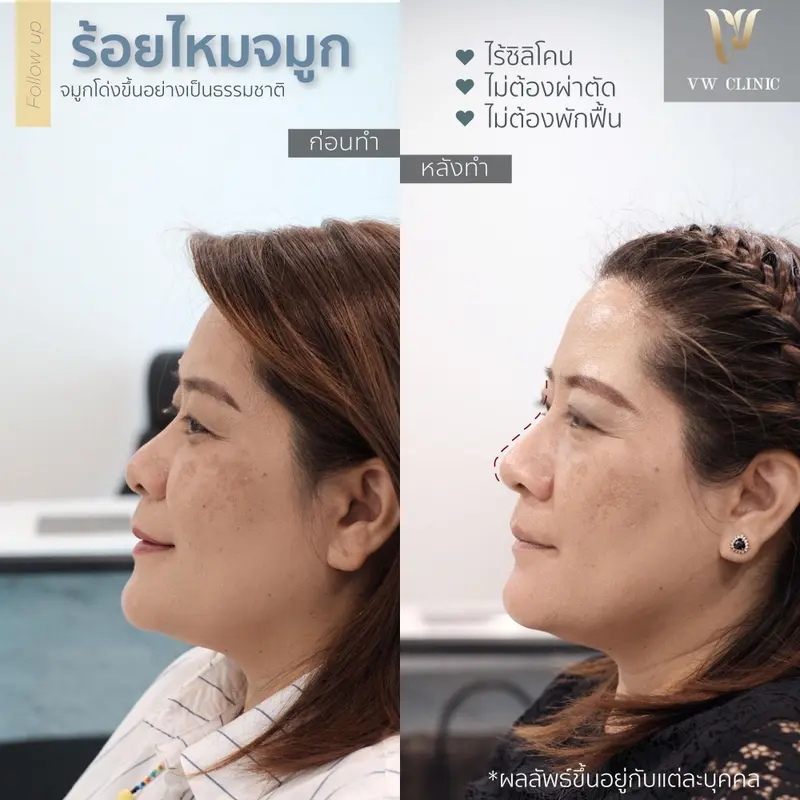 ร้อยไหมจมูก