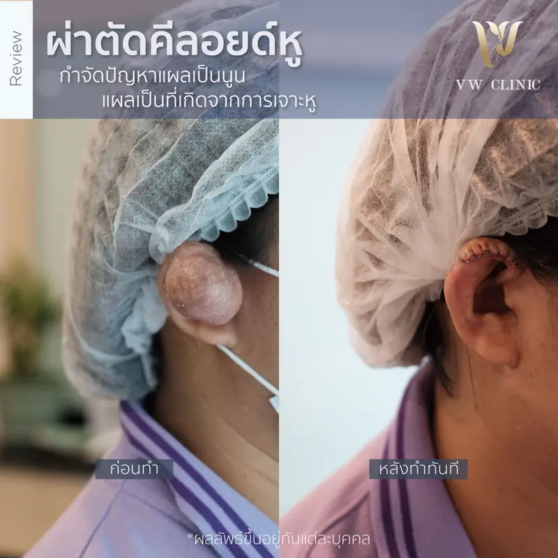 ผ่าตัดคีลอยด์หู