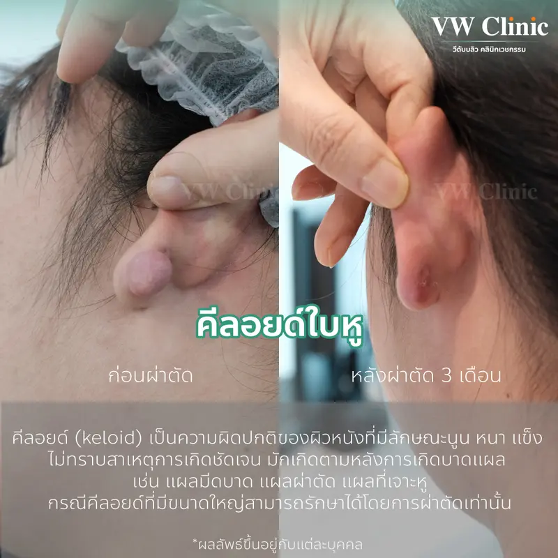 ผ่าตัดคีลอยด์หู