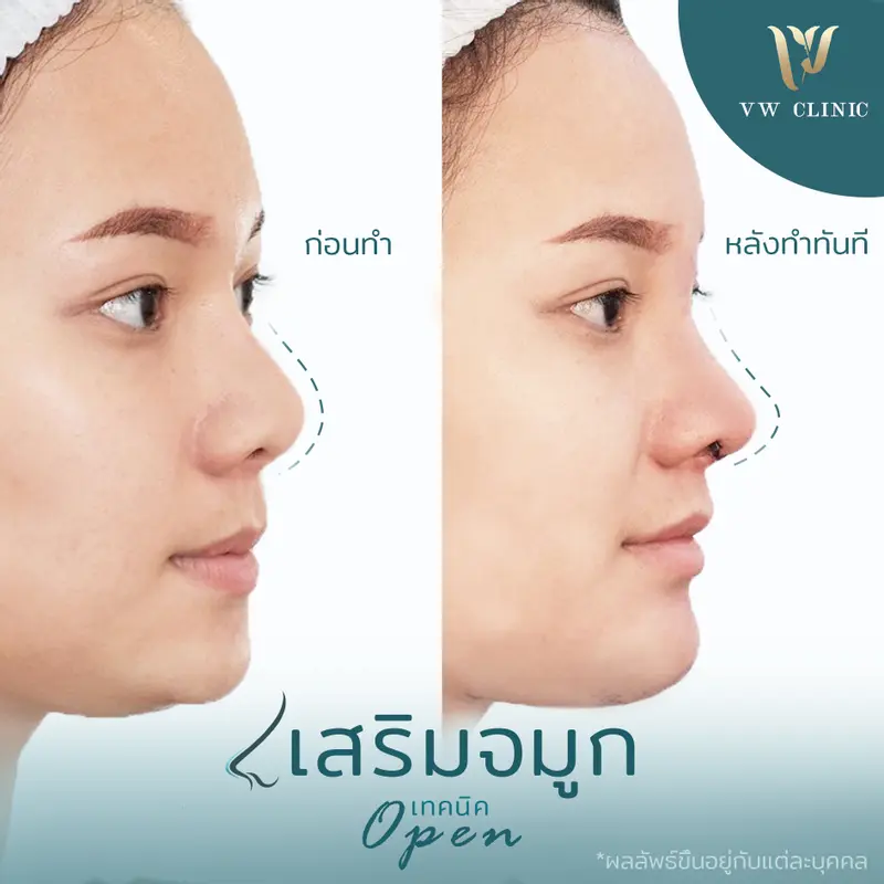 เสริมจมูก