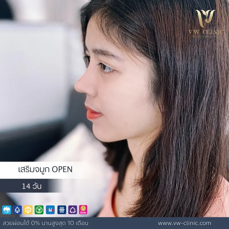 Follow up จมูก 14 วัน