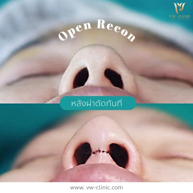 เสริมจมูกเทคนิคโอเพ่น 