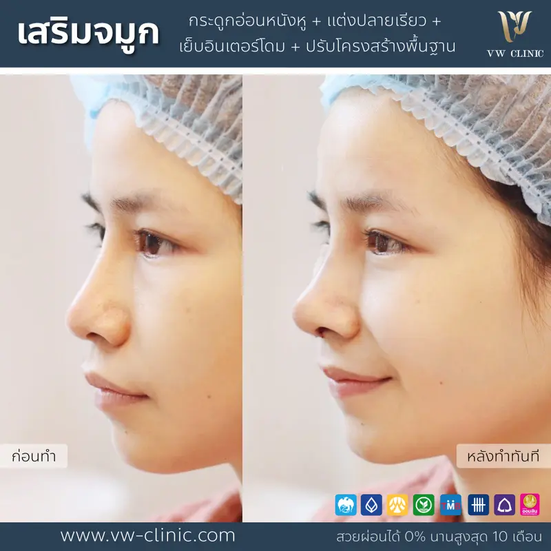 เสริมจมูก เทคนิคโอเพ่น