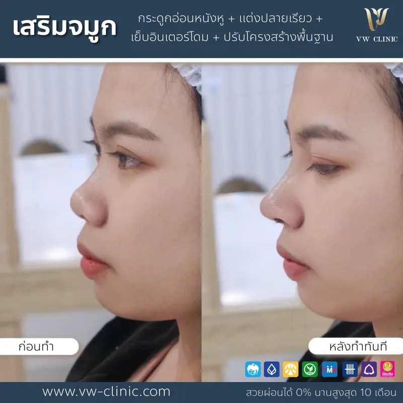 เสริมจมูกเทคนิคโอเพ่น