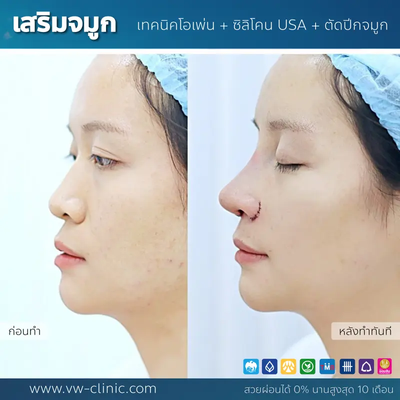 เสริมจมูก Open