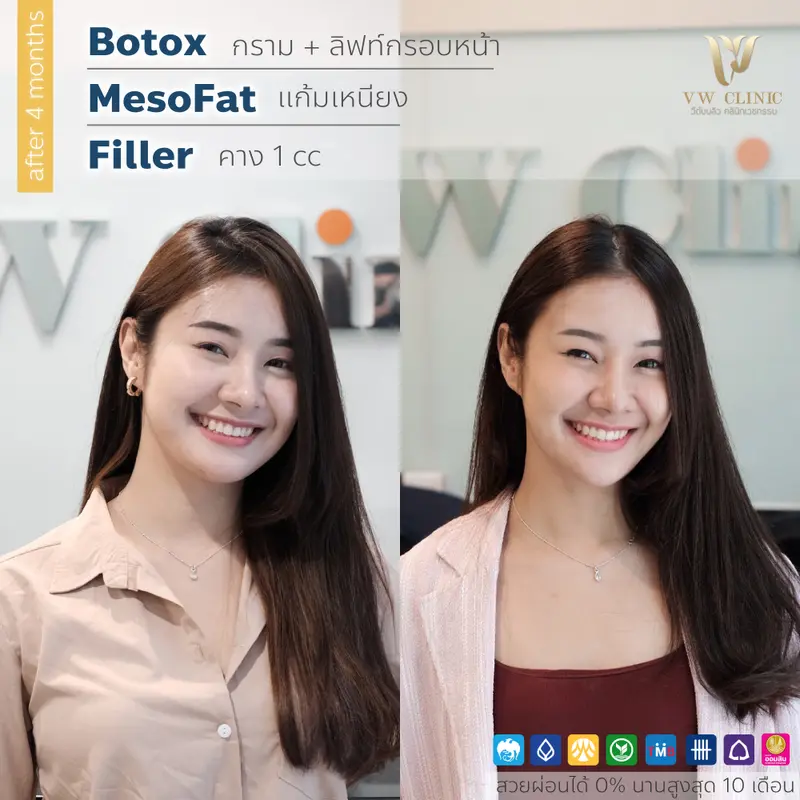 Filler + Botox + Fat