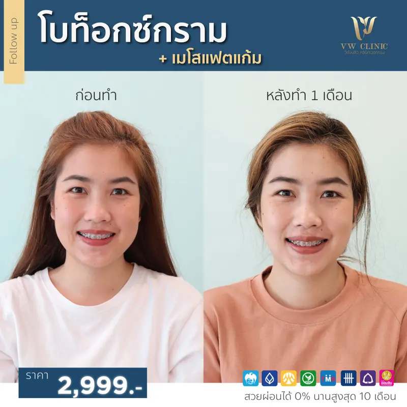 Botox กราม