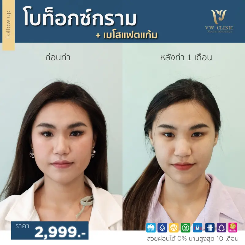 Botox กราม