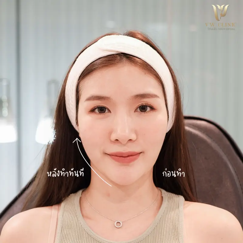 Botox lift กรอบหน้า