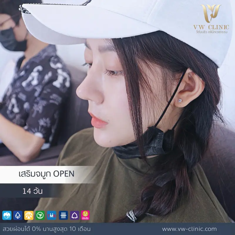 เสริมจมูก Open