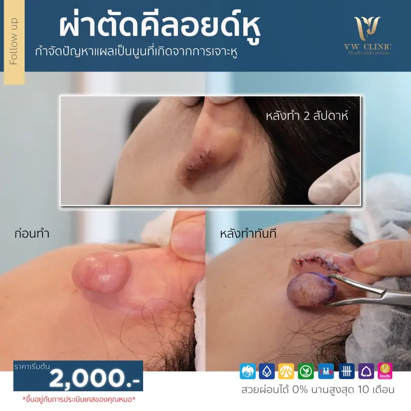 ผ่าตัดคีลอยด์หู