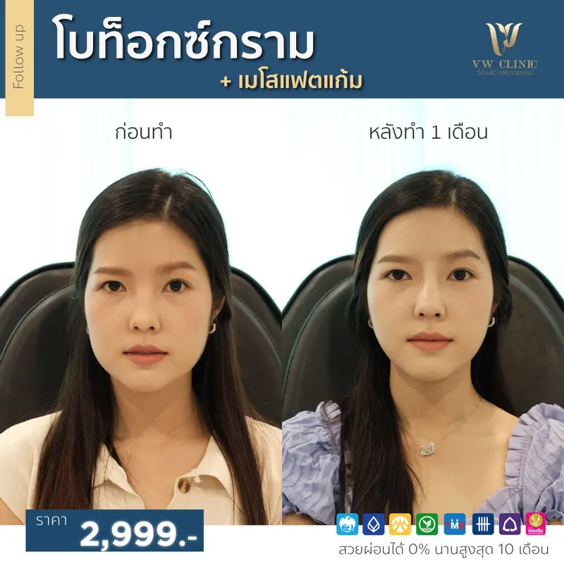 Botox กราม
