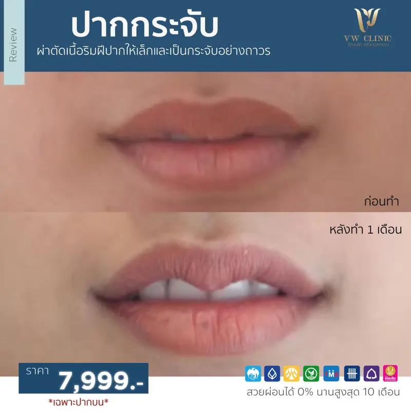 ผ่าตัดปากกระจับ
