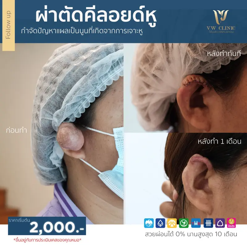 ผ่าตัดคีลอยด์หู