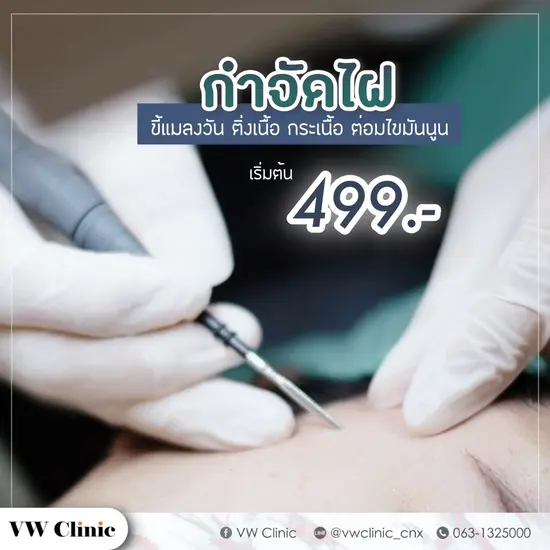 กำจัดไฝ ขี้แมลงวัน กำจัดไฝ ขี้แมลงวัน