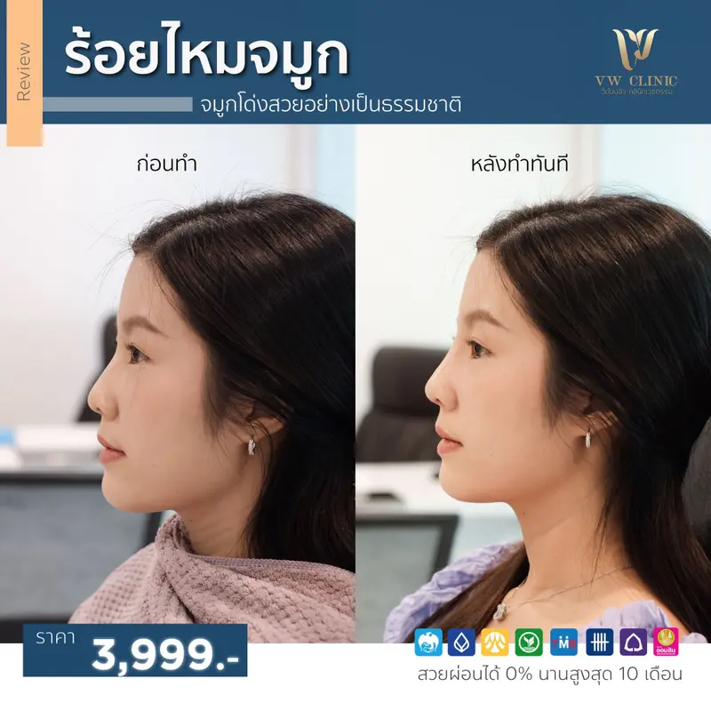 ร้อยไหมจมูก