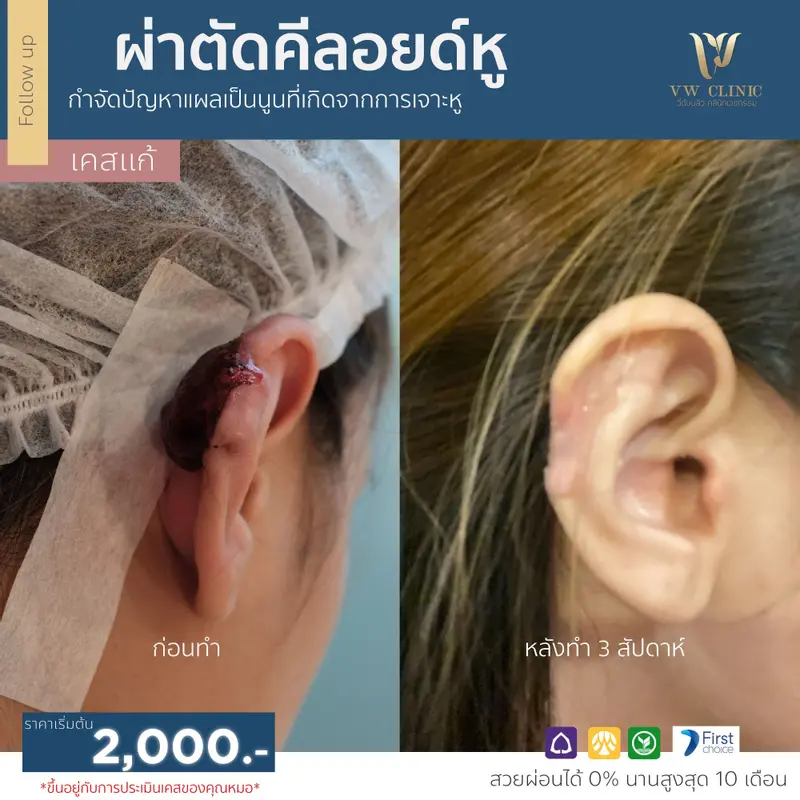 ผ่าตัดคีลอยด์หู